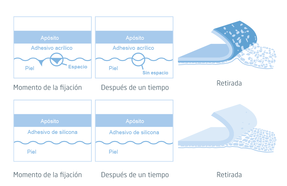 Ilustración que muestra las diferencias entre los adhesivos estándar y los de silicona en la aplicación, a lo largo del tiempo, y en la retirada. Ilustración que muestra las diferencias entre los adhesivos estándar y los de silicona en la aplicación, a lo largo del tiempo, y en la retirada.